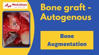 Autogenous Bone Grafts