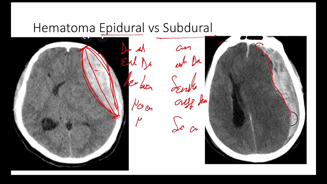 Diferencia En 2 Minutos De Hematoma Epidural Vs Subdural Tomografía