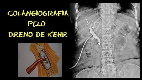 Quando retirar o dreno de Kehr?
