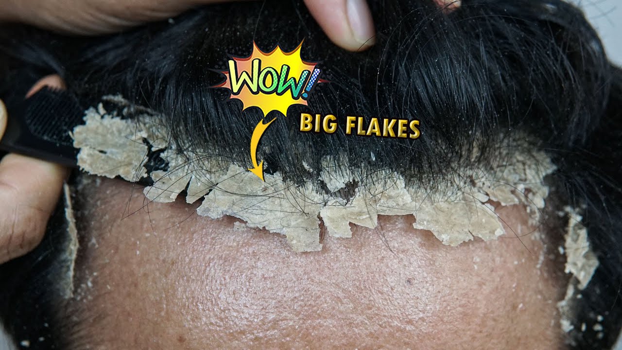 Scratching Big Dandruff Flakes Satisfying 