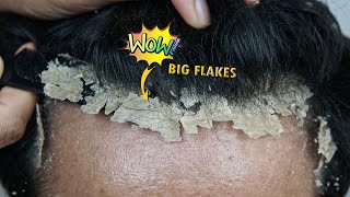 Scratching Big Dandruff Flakes Satisfying