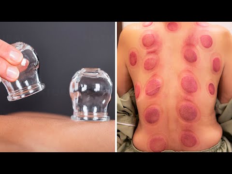 Cupping Therapy: An Ancient Technique With Many Health Benefits (Hijama Therapy)