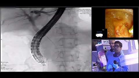 ERCP with biliary radiofrequency ablation + stent placement by Dr. Mohan Ramchandani