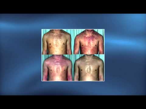 Topical steroid addiction in atopic dermatitis - Video abstract 69201