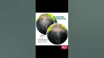 Trước & Sau Xăm Tóc tại VNSCALP – Lột Xác Ngoạn Mục!