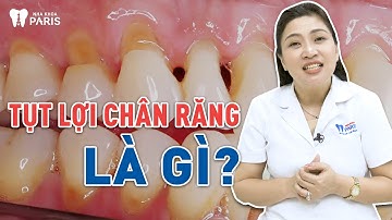 Tụt lợi chân răng: Nguyên nhân và cách điều trị | Nha khoa Paris