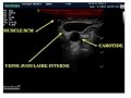 Abord veineux central sous echoguidage par le dr bouarroudj noreddine