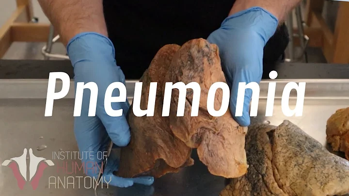 What Is Pneumonia? - DayDayNews