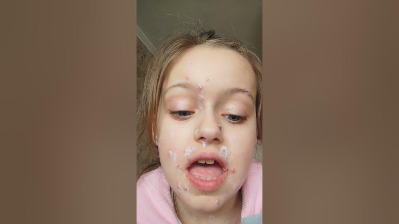 мне с этой ветрянкой даже зубы нельзя нормально почистить, потому что у ...