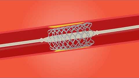 Tecnical way to open blood blockage 