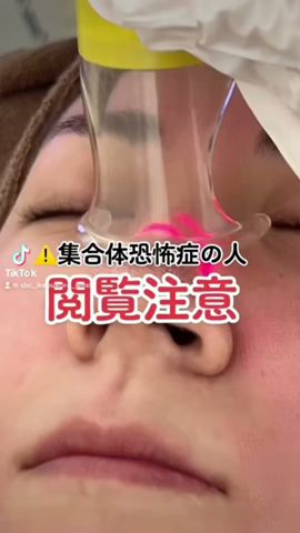 いちご鼻対策に!スタッフ人気も高い施術です!#湘南美容クリニック #美容 #美容整形 #プチ整形 #看護師 #美肌ケア #レーザー #shorts