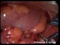 laparoscopic rectopexy for rectal prolapse