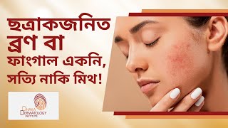 ছত্রাকজনিত ব্রণ বা ফাংগাল একনি, সত্যি নাকি মিথ! Acne Treatment