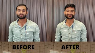 Non Surgical Hair Replacement In Bangalore | Wigs Castle Hair Fixing | 9577295779, 9739889849