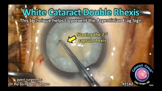 CataractCoach™ 2182: white cataract double rhexis technique
