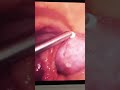 Laparoscopic tubal ligation in patient with previous 2 LSCS # female sterilization # viral