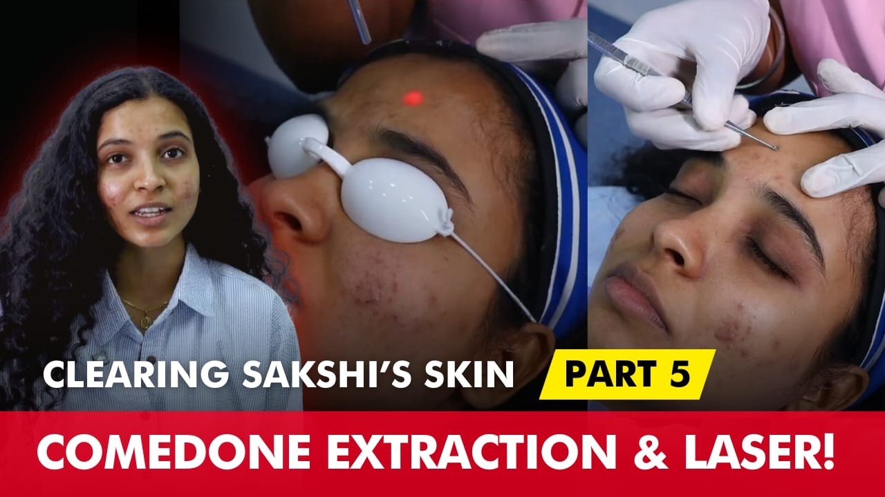 Three Sessions In! Sakshi’s Clear Skin Progress with Fotona Laser Treatment |Clear Skin Clinic, Pune