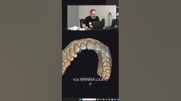 Choosing the anatomy for a mockup! #aadentalondemand #digitaldentistry #exocad #mockup