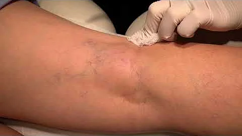 Treating spider and varicose veins with sclerother...