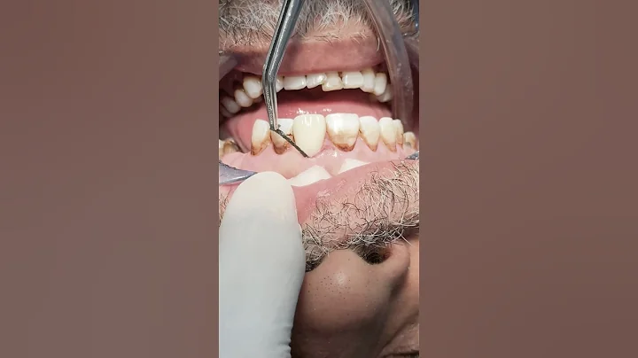 Composite veneer for anterior teeth in my dental clinic #shorts