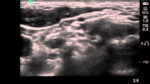 intermediate cervical plexus block+ISB