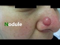 Papule pustule vesicule bulle nodule macule