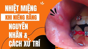 Nhiệt miệng khi niềng răng | Tt niềng răng quốc tế Diamond