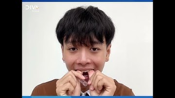 CÔNG NGHỆ NIỀNG RĂNG TRANSALIGN