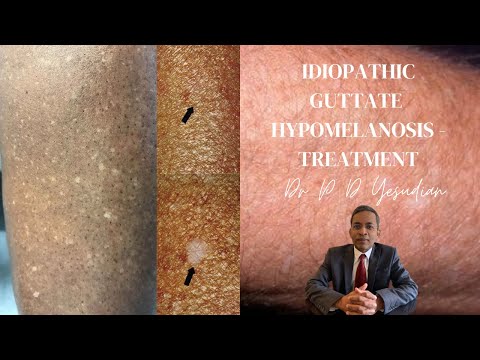 Видео: Идиопатик гуттатын гипомеланозыг эмчлэх 3 арга