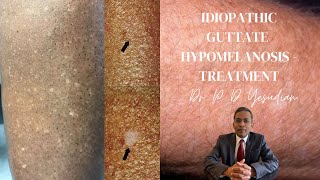Idiopathic guttate hypomelanosis - a review with emphasis on treatment
