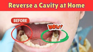Download Lagu How to Reverse a Cavity at Home | Medical Miracle MP3