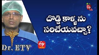 How To Correct Bow Legs ? దడడ కళళ న సరచయవచచ? Dr.etv 27Th August 2021
