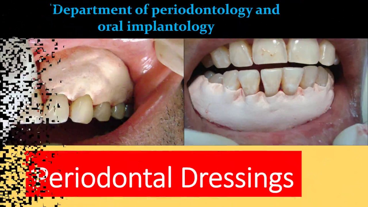 Periodontal Dressing periodontal-dressing