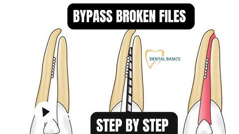 Easily Bypass Broken Files | A Clinical Guide