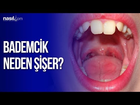 Bademcik neden şişer? Bademcik şişmesi tedavisi | Sağlık | Nasil.com