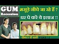 मसूड़े नीचे जा रहे हैं तो घर पे करें ये इलाज | gum recession treatment at home | masude niche jana