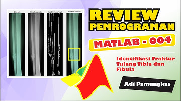 Review Pemrograman MATLAB - 004 - Identifikasi Fraktur Tulang Menggunakan Support Vector Machine
