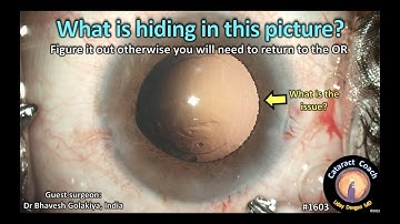 CataractCoach 1603: what is hiding in this picture?