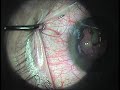 2nd phacoemulsification cataract surgery