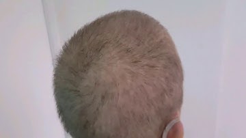 post chemo Hair Density Recovery SMP Scalp Micropigmentation 1st session by El Truchan
