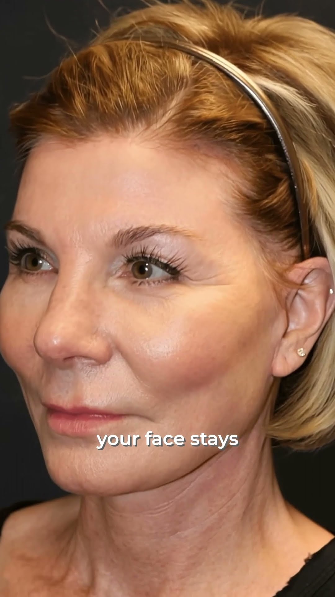The secret to a natural-looking facelift