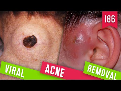 VIRAL ACNE REMOVAL  / PIMPLE POPPING