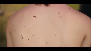 Dermatologist shares warning signs of melanoma