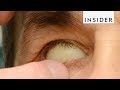 How Prosthetic Eyes Are Made