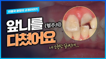 앞니를 다쳤을 때, 치료 방법은? [*사진주의*]치아파절, 뿌리파절, 치아빠짐