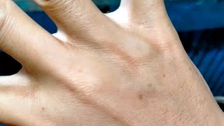 CARA MENGHILANGKAN BINTIK BINTIK HITAM DI TANGAN