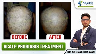 6 महीनो में कैसे हुआ Scalp Psoriasis ठीक? | Scalp Psoriasis Treatment | Psoriasis Treatment India