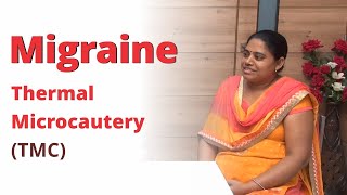 Migraine Treatment | Thermal Microcautery | Migraine relief by Ayurvedic Agnikarma Treatment