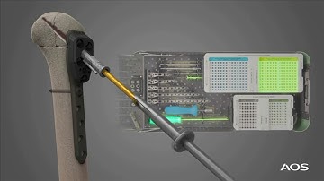 Proximal Humeral Plate Surgical Technique Video