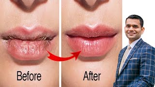 Get Pink And Baby Soft Lips Naturally At Home | Reasons For Dry Lips And it